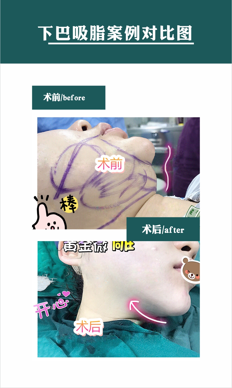 💆 Tạo hình cằm V-line