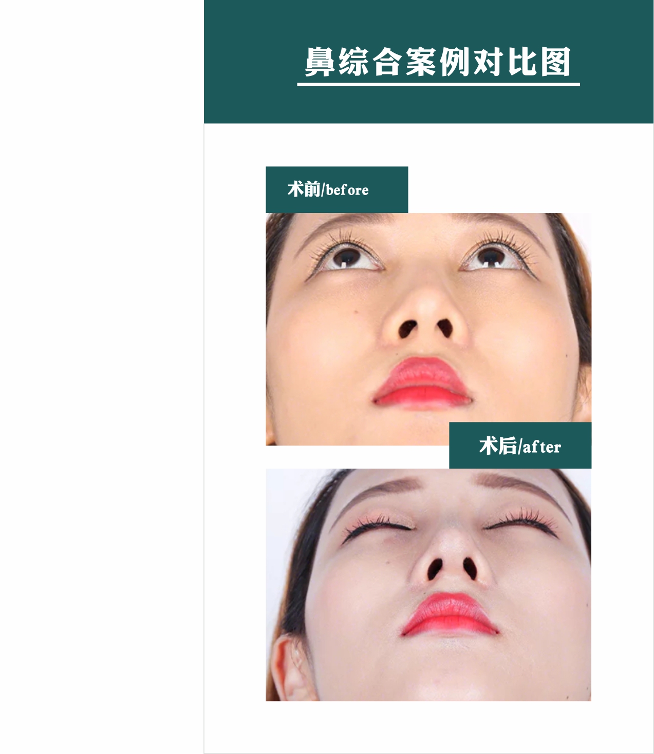 👃 Nâng mũi S-line